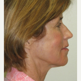 55-64 year old woman treated with Sculptra and Skin Tightening Laser after 3243217
