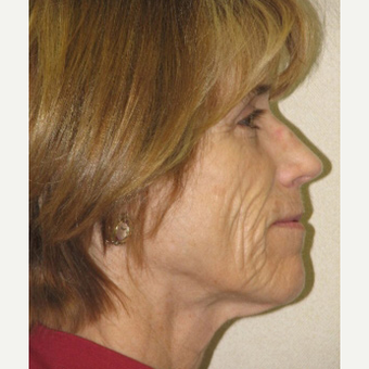 55-64 year old woman treated with Sculptra and Skin Tightening Laser before 3243217