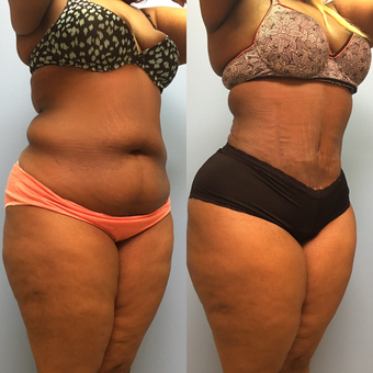 30 year old woman treated with Tummy Tuck and Lipo 360 before 3174798