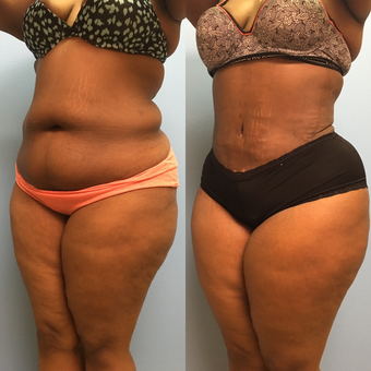 30 year old woman treated with Tummy Tuck and Lipo 360 after 3174798