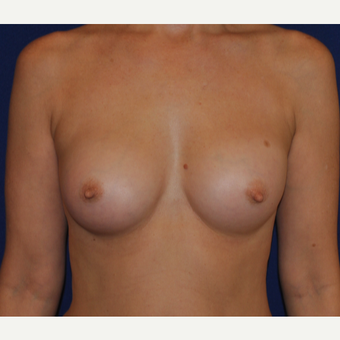 50 year old woman treated with Breast Augmentation after 3776256