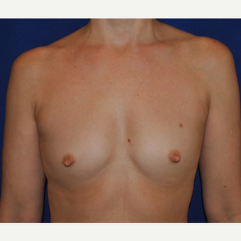 50 year old woman treated with Breast Augmentation before 3776256