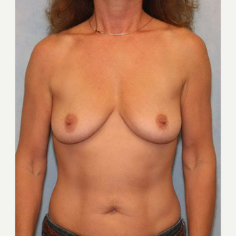45-54 year old woman treated with Breast Augmentation before 3487417