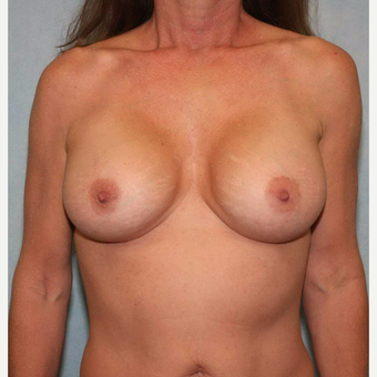 45-54 year old woman treated with Breast Augmentation after 3487417