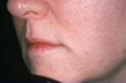 Lip Augmentation after 297530
