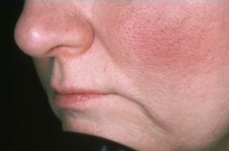 Lip Augmentation before 297530