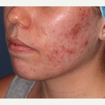 18-24 year old woman treated with Laser Treatment before 3149520