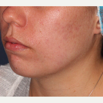 18-24 year old woman treated with Laser Treatment after 3149520