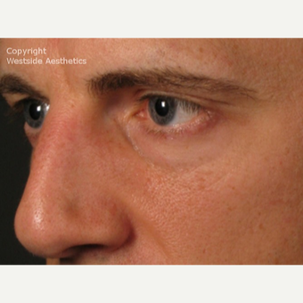 Non Surgical Under Eyes on Middle-Aged Man before 2977596