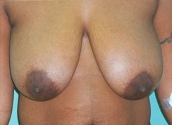 Breast Lift with Implants before 1655870