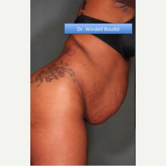 35-44 year old woman treated with Liposuction before 1651764