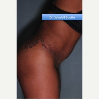 35-44 year old woman treated with Liposuction after 1651764