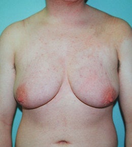 41-Year-Old Male Breast Reduction before 668286
