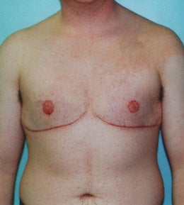 41-Year-Old Male Breast Reduction after 668286