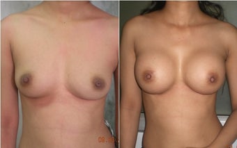Breast Augmentation before 1199831