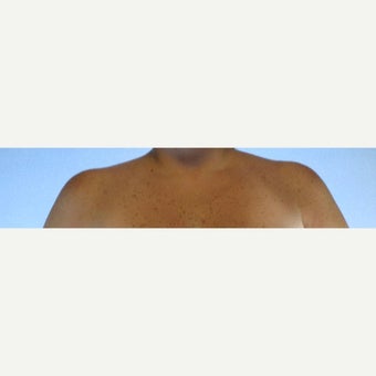 35-44 year old woman treated with Fat Transfer after 2006223