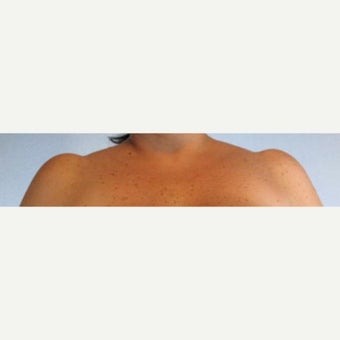 35-44 year old woman treated with Fat Transfer before 2006223