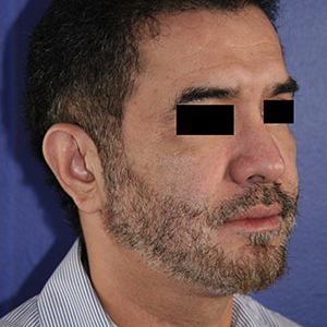 46 year old man treated with Chin Implant after 3710605