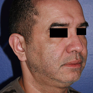 46 year old man treated with Chin Implant before 3710605