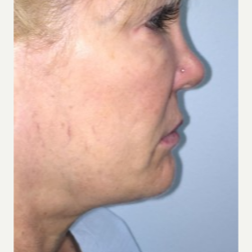 45-54 year old woman treated with Smart Lipo to the chin and neck before 3414765