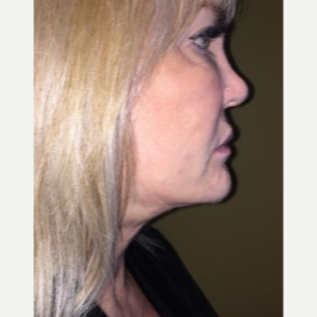 45-54 year old woman treated with Smart Lipo to the chin and neck after 3414765