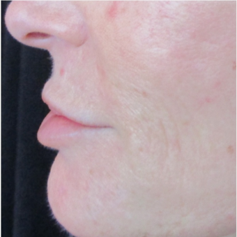 54 year old woman pre and post 1 syringe of Juvederm before 3056490