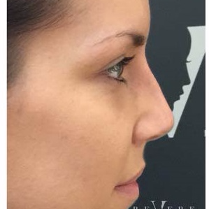 Non Surgical Nose Job at Revere Clinics after 3107161