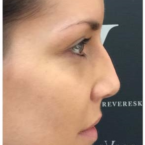 Non Surgical Nose Job at Revere Clinics before 3107161