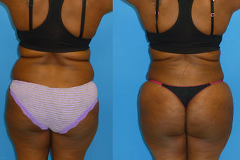 38 Year Old Female Underwent Brazilian Butt Lift - BBL (Fat Transfer to Buttocks) before 1142969