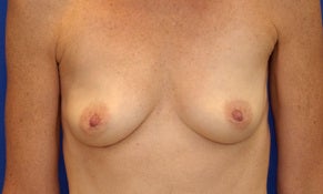 48 Year Old Female with Breast Augmentation before 1178540