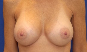 48 Year Old Female with Breast Augmentation after 1178540