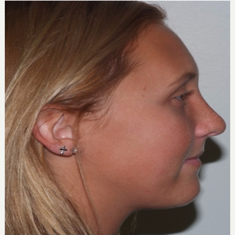 Rhinoplasty after 3324374