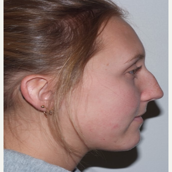Rhinoplasty before 3324374