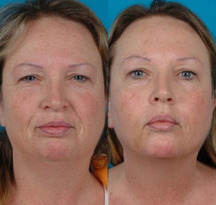 51-year-old woman treated with Juvéderm. before 3287668