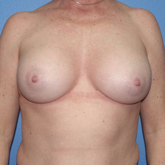 45-54 year old woman treated with Breast Augmentation after 3400518