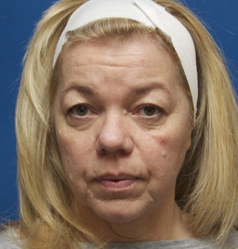 52 Year Old Female treated for hollowing in the cheeks before 1259903