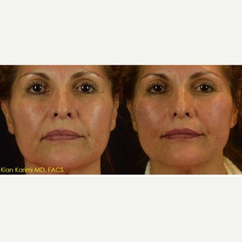 Lifting of Cheeks and Lower Third of Face with NovaThreads before 2629656