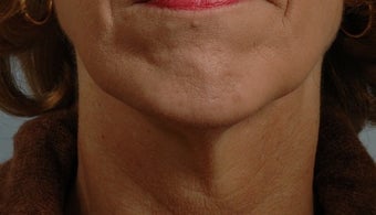 55-64 year old woman treated with Ultherapy after 1617362