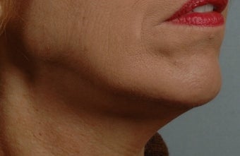 55-64 year old woman treated with Ultherapy 1617362