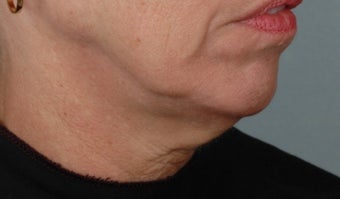 55-64 year old woman treated with Ultherapy 1617362
