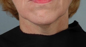 55-64 year old woman treated with Ultherapy before 1617362