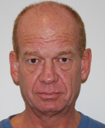 Blepharoplasty and Sculptra before 1508328