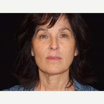55-64 year old woman treated with Facelift before 3508754