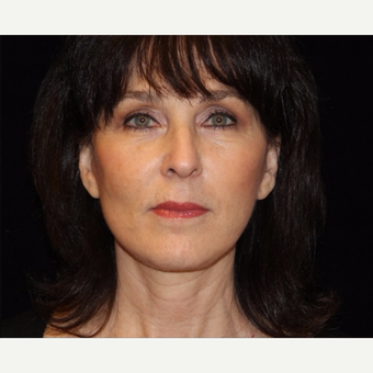 55-64 year old woman treated with Facelift after 3508754