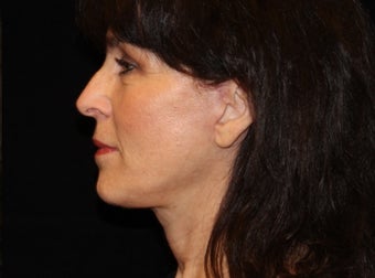55-64 year old woman treated with Facelift 3508754