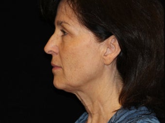 55-64 year old woman treated with Facelift 3508754