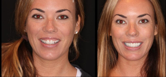 Before & After Smile Make-Over-Upper 8 Veneers before 664427