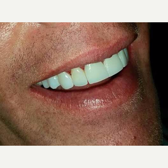 35-44 year old man treated with Smile Makeover after 3221133