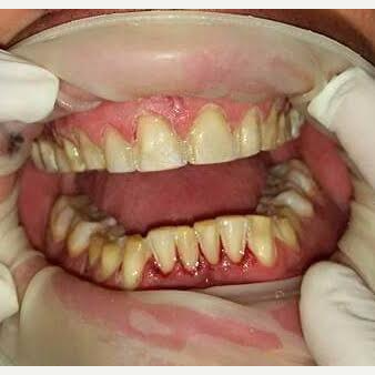 35-44 year old man treated with Smile Makeover before 3221133