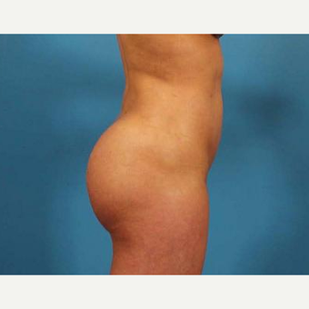 25-34 year old woman treated with Brazilian Butt Lift after 3093503